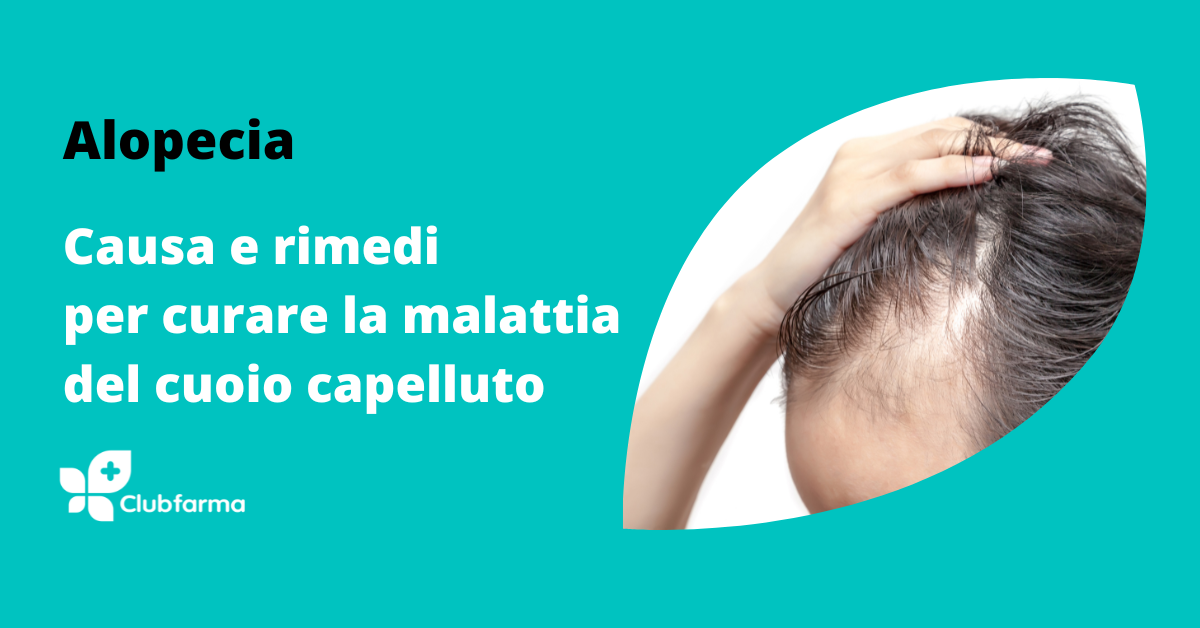 Alopecia: cause e rimedi per curare la malattia del cuoio capelluto